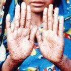 Skin lesions caused by exposure to arsenic