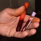 Abalaka claims to have created a HIV vaccine from patient's blood