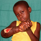 Child with buruli ulcer