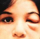 A Brazilian girl with Chagas disease