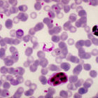 Micrograph of Chagas disease parasite in blood sample Micrograph of Chagas disease parasite in blood sample