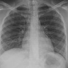 Chest X-ray