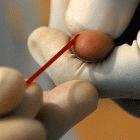 Some HIV-2 patients can eradicate the virus from their blood