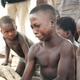 Girl with guinea worm infection