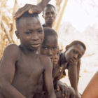 scientist girl suffering from Guinea worm infection