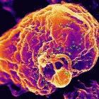 The HIV virus (green) infecting a white blood cell.