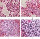Slides showing H5N1 infection in human lungs (A–C) and spleen (D)