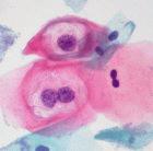 A vaccine could prevent abnormal cells like these growing on the cervix
