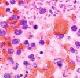 A microscopic picture of the lung of a patient with plague