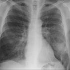 X-ray showing pneumonia