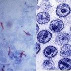 TB (left) and HIV (right) must be treated together