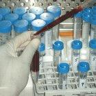 Diagnosing TB in Uganda