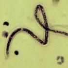 The worm <i>Wuchereria bancrofti</i> causes the neglected disease elephantiasis