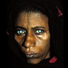 Cataracts