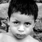 A child from Panama suffering from Chagas disease