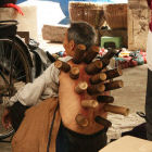 Cupping in China