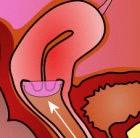 Diaphragms did not help in preventing HIV infection