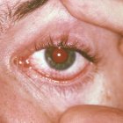 Eyes