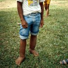 Boy with filariasis