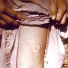 Leishmaniasis paitent