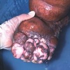 Lymphatic filariasis