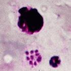 Ugandan researchers have found how malaria causes blood cells to clump 