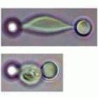 Optical tweezers stretch a healthy red blood cell (top) and a cell in a late stage of infection with the <i>P. falciparum</i> malaria parasite (bottom)