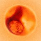 The malaria parasite developing inside a red blood cell