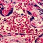 A malaria-infected placenta: red blood cells are at the centre of the image, with malaria parasites appearing as black dots