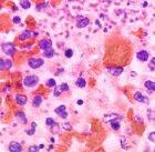 A microscopic picture of the lung of a patient with plague