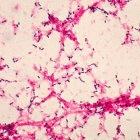 Pneumoccoccal disease is a major public health problem all over the world