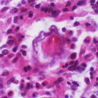 Schistosomal egg