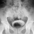 Schistosomiasis on the urinary bladder