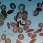 sicklecell