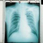 Chest X-ray of a patient with TB