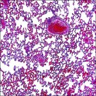 A TB-infected lung
