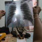 X-ray of patient with TB